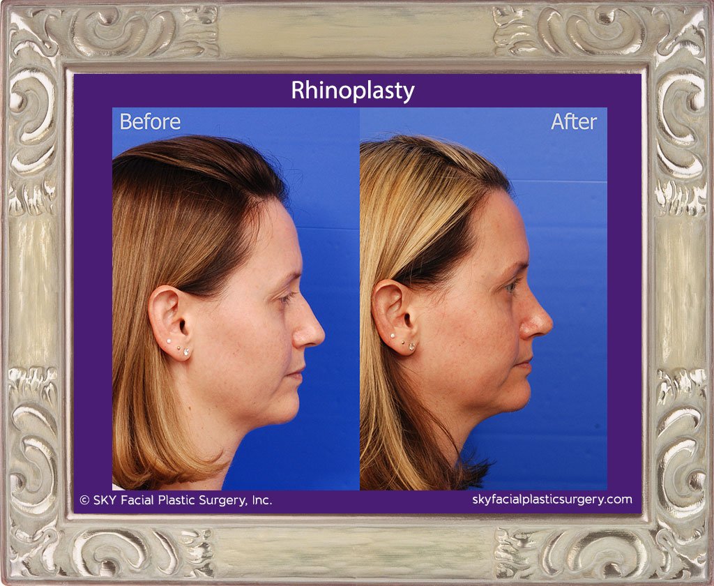 SKY-Facial-Plastic-Surgery-Rhinoplasty-30E.jpg