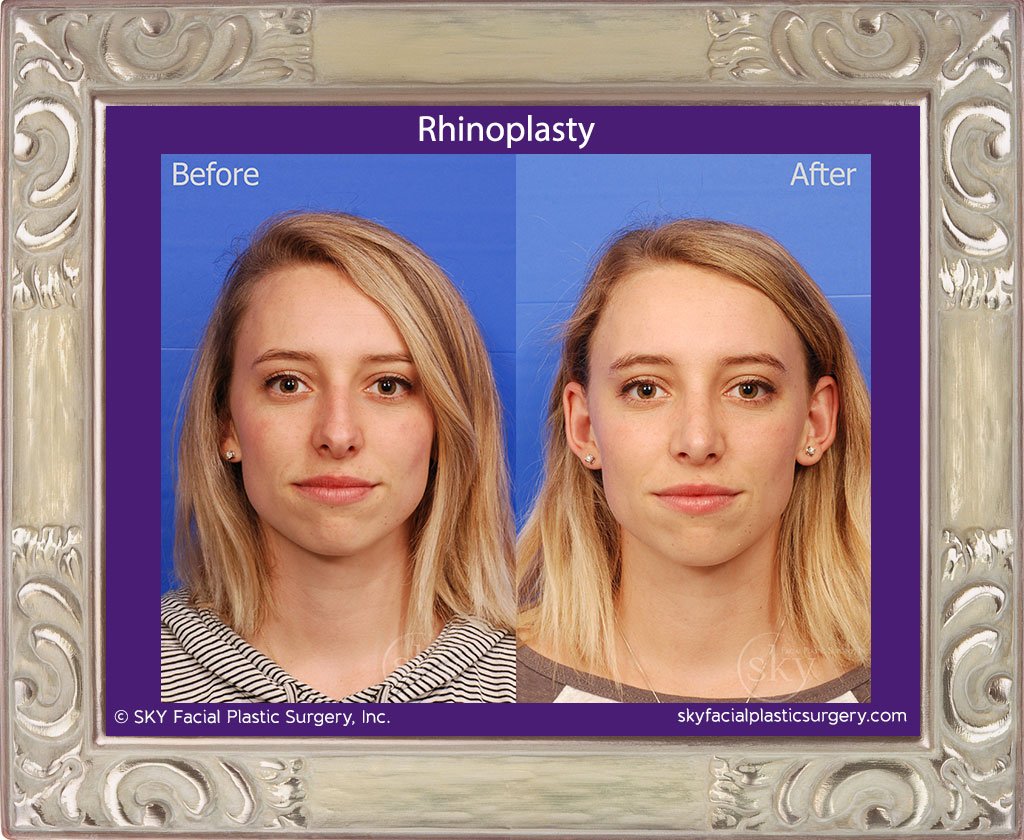 SKY-Facial-Plastic-Surgery-Rhinoplasty-31A.jpg