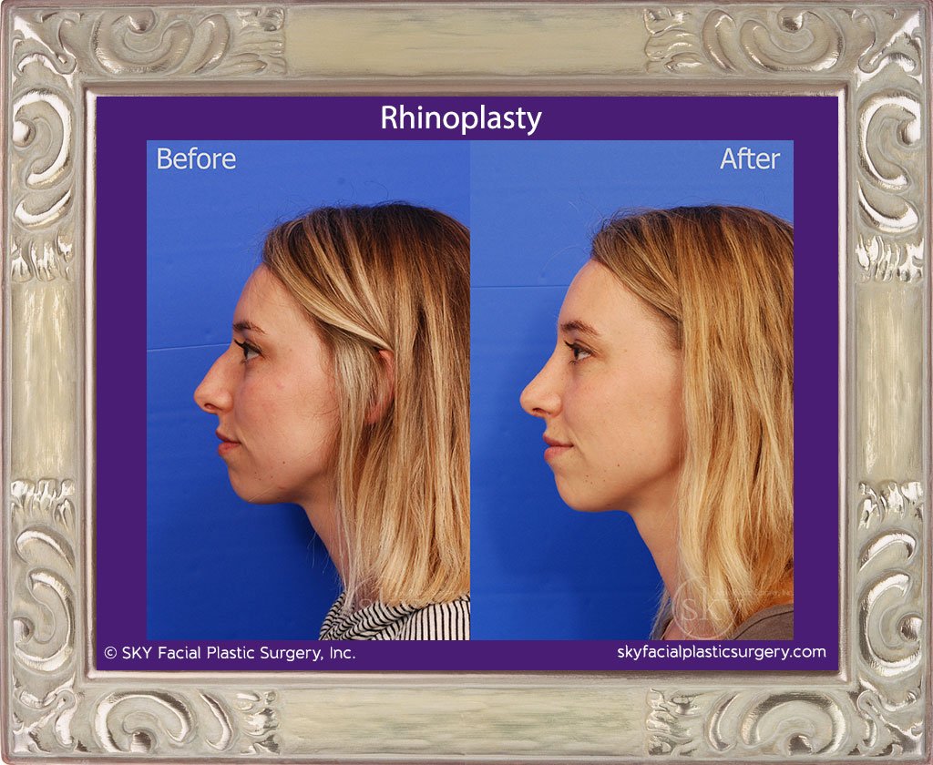 SKY-Facial-Plastic-Surgery-Rhinoplasty-31B.jpg