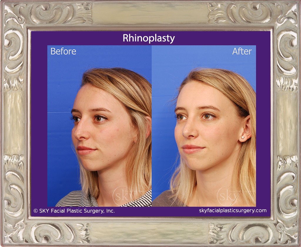 SKY-Facial-Plastic-Surgery-Rhinoplasty-31C.jpg
