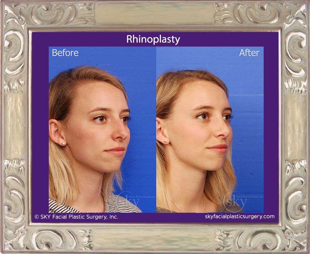 SKY-Facial-Plastic-Surgery-Rhinoplasty-31D.jpg