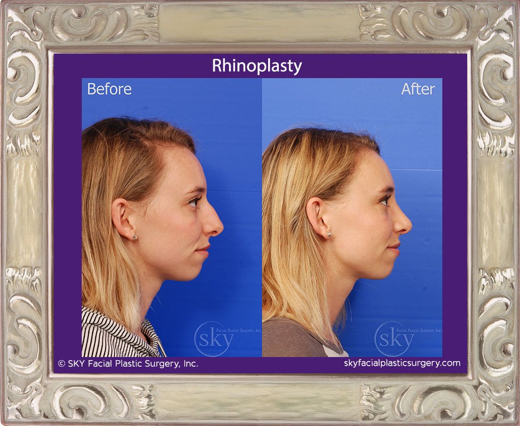 SKY-Facial-Plastic-Surgery-Rhinoplasty-31E.jpg
