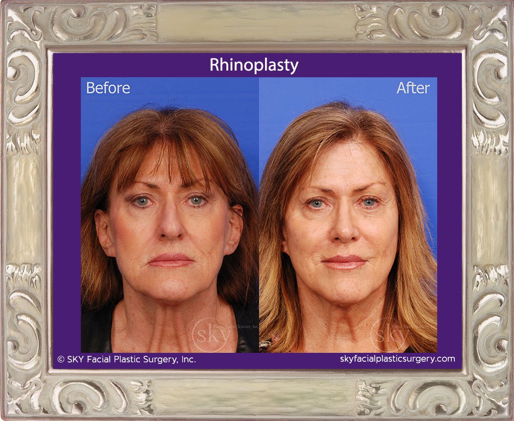 SKY-Facial-Plastic-Surgery-Rhinoplasty-32A.jpg