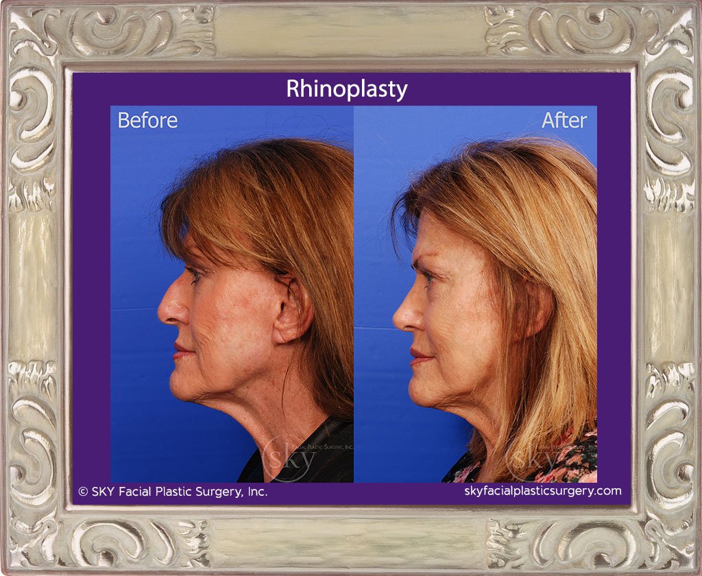 SKY-Facial-Plastic-Surgery-Rhinoplasty-32B.jpg