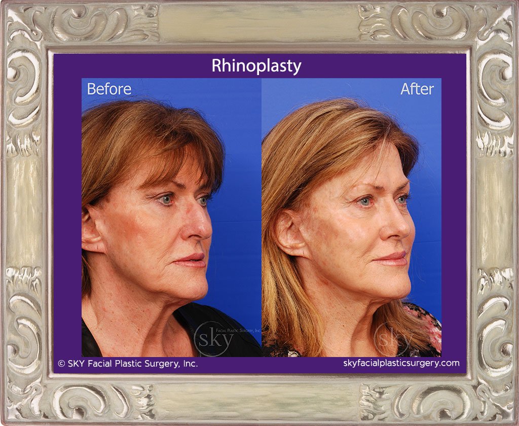 SKY-Facial-Plastic-Surgery-Rhinoplasty-32D.jpg
