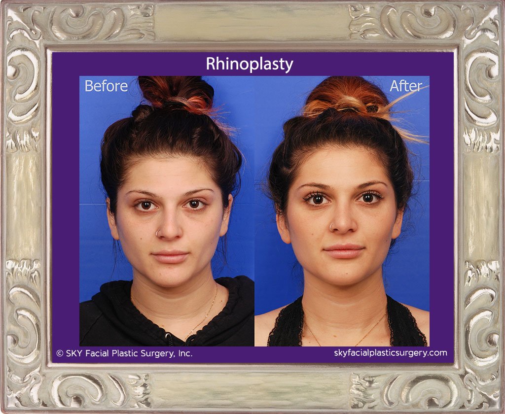 SKY-Facial-Plastic-Surgery-Rhinoplasty-33A.jpg