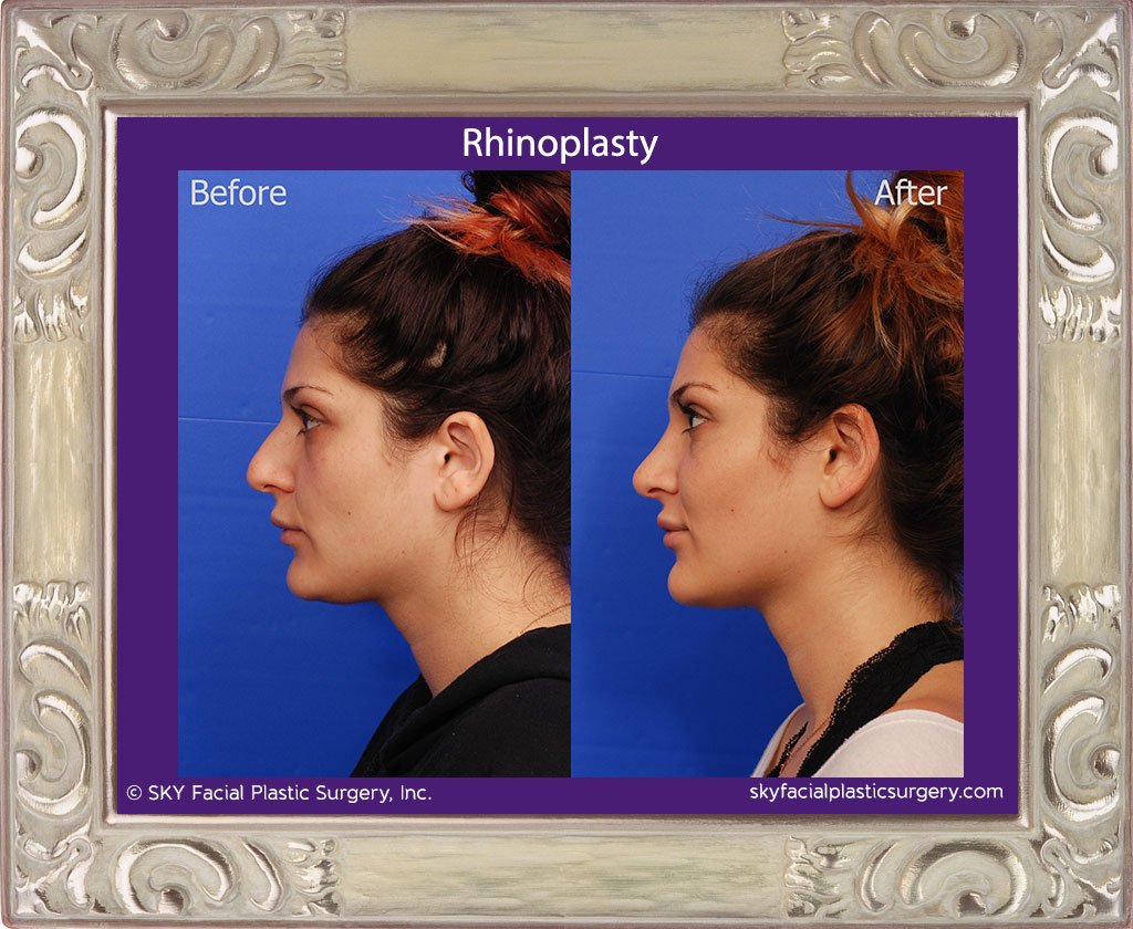 SKY-Facial-Plastic-Surgery-Rhinoplasty-33B.jpg