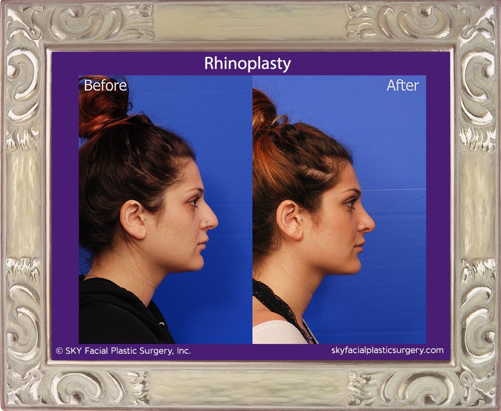 SKY-Facial-Plastic-Surgery-Rhinoplasty-33E.jpg