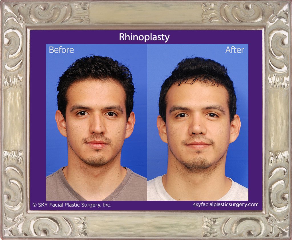 SKY-Facial-Plastic-Surgery-Rhinoplasty-34A.jpg