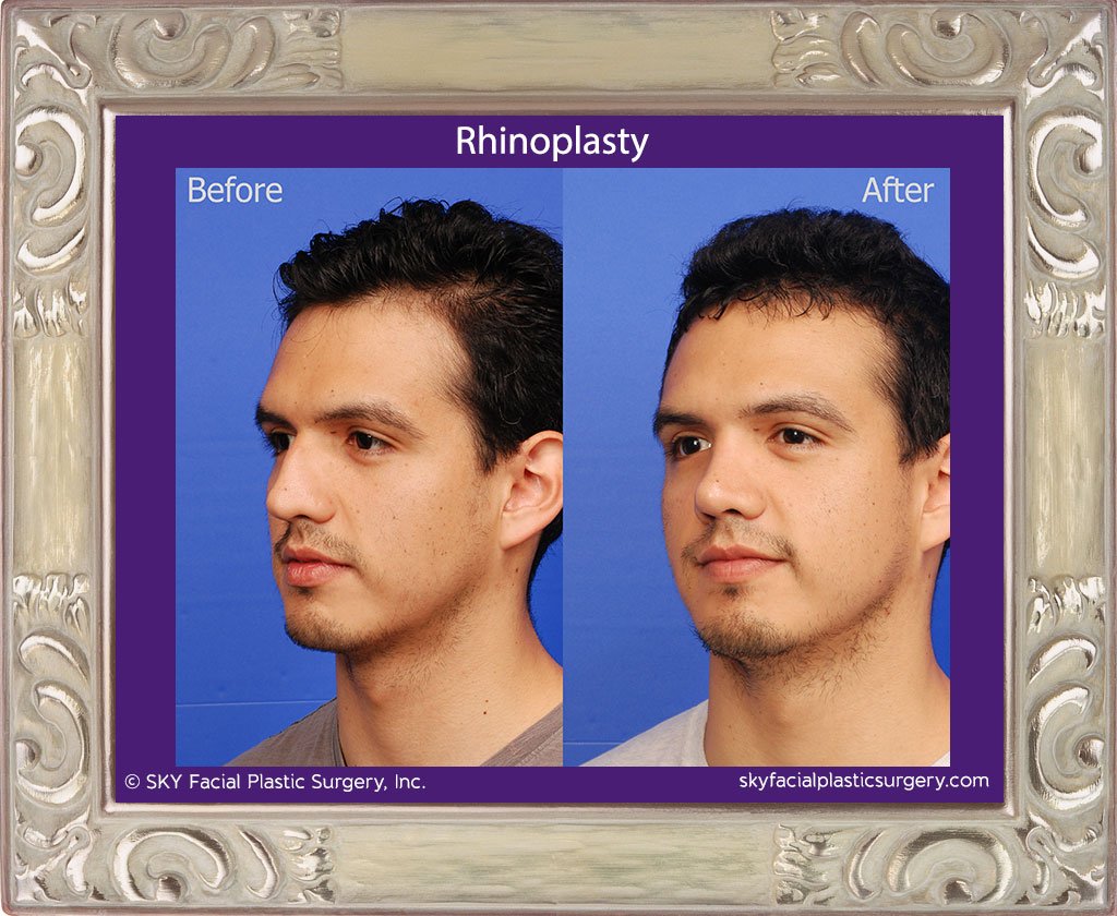 SKY-Facial-Plastic-Surgery-Rhinoplasty-34C.jpg
