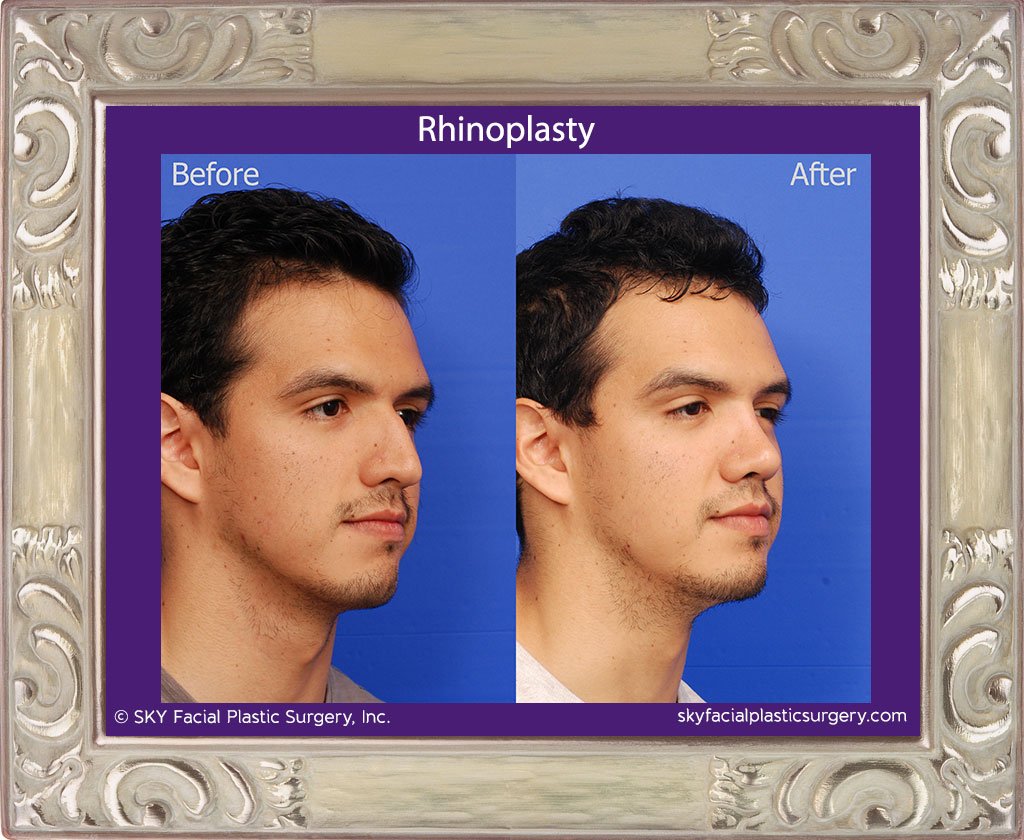 SKY-Facial-Plastic-Surgery-Rhinoplasty-34D.jpg
