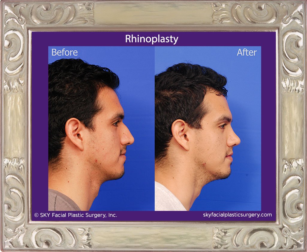 SKY-Facial-Plastic-Surgery-Rhinoplasty-34E.jpg