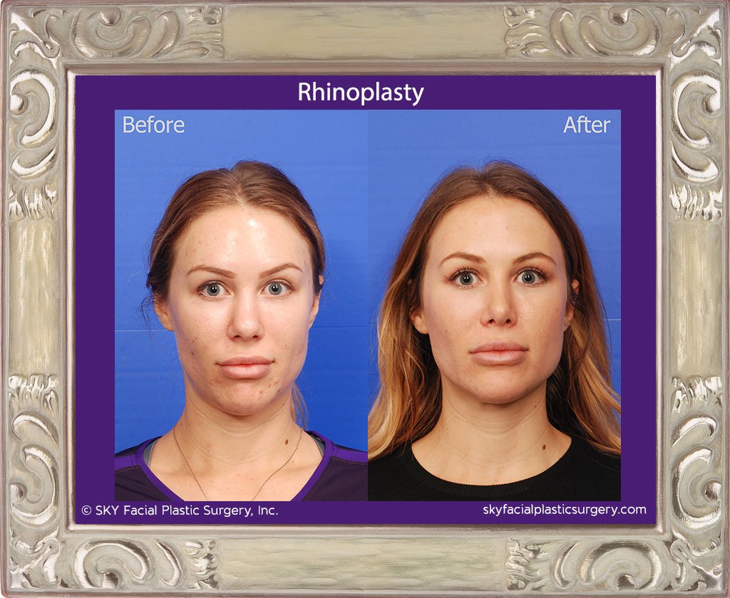 SKY-Facial-Plastic-Surgery-Rhinoplasty-35A.jpg