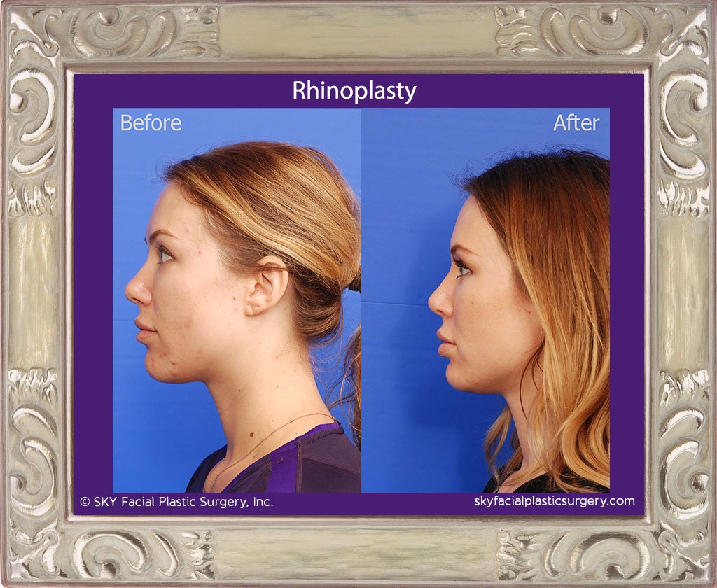 SKY-Facial-Plastic-Surgery-Rhinoplasty-35B.jpg