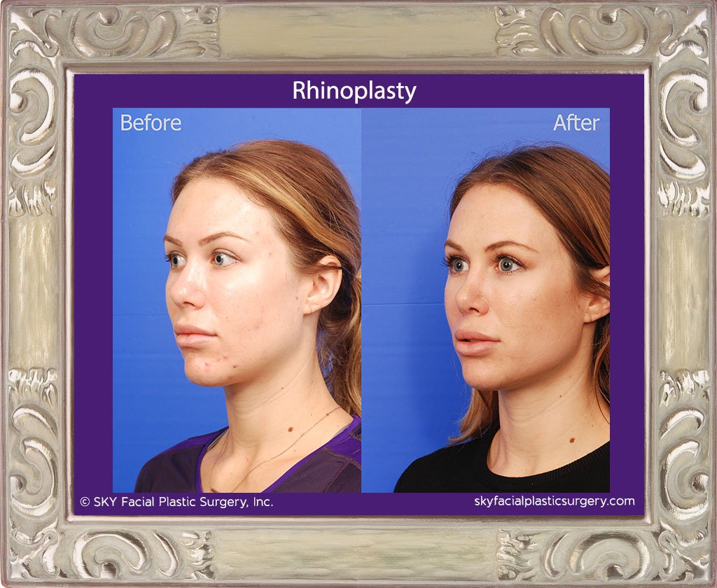 SKY-Facial-Plastic-Surgery-Rhinoplasty-35C.jpg