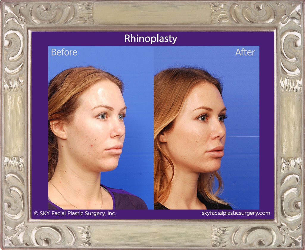 SKY-Facial-Plastic-Surgery-Rhinoplasty-35D.jpg