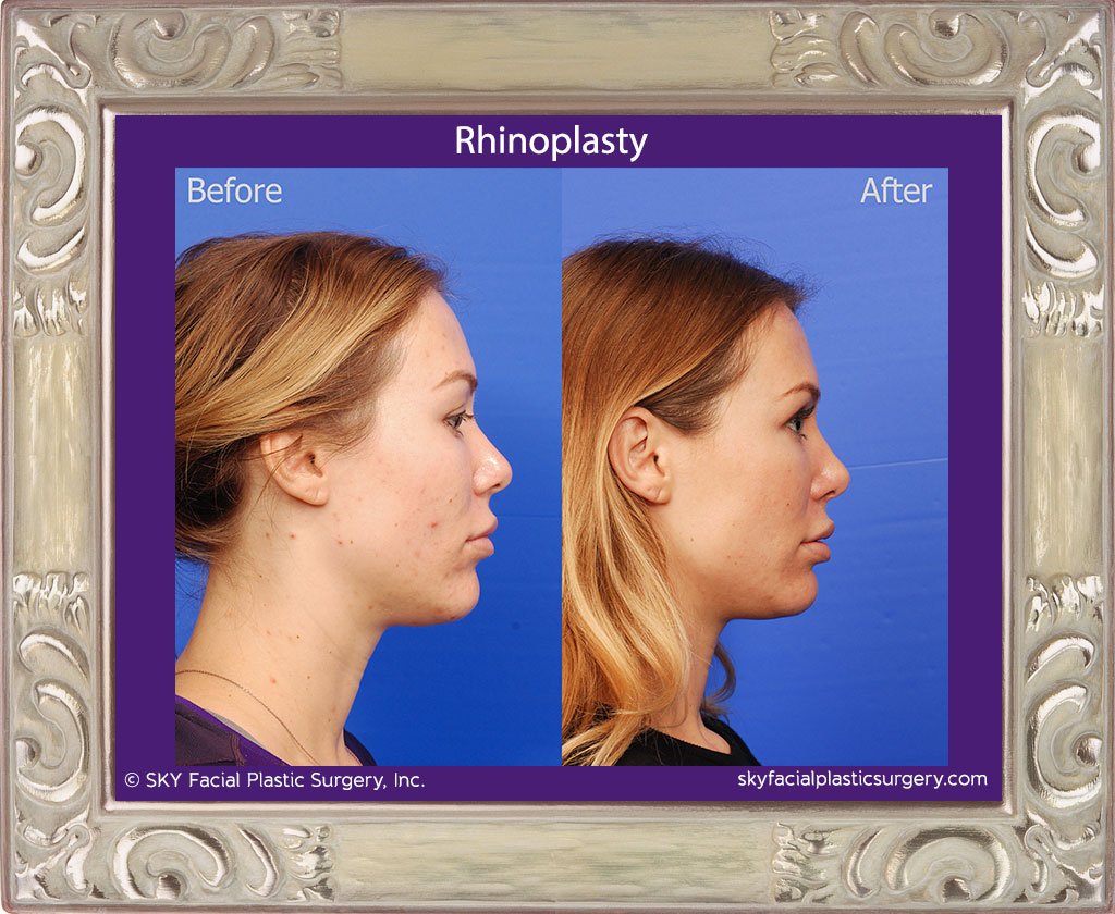 SKY-Facial-Plastic-Surgery-Rhinoplasty-35E.jpg