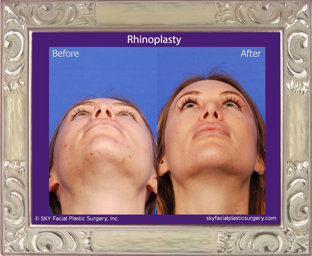 SKY-Facial-Plastic-Surgery-Rhinoplasty-35F.jpg