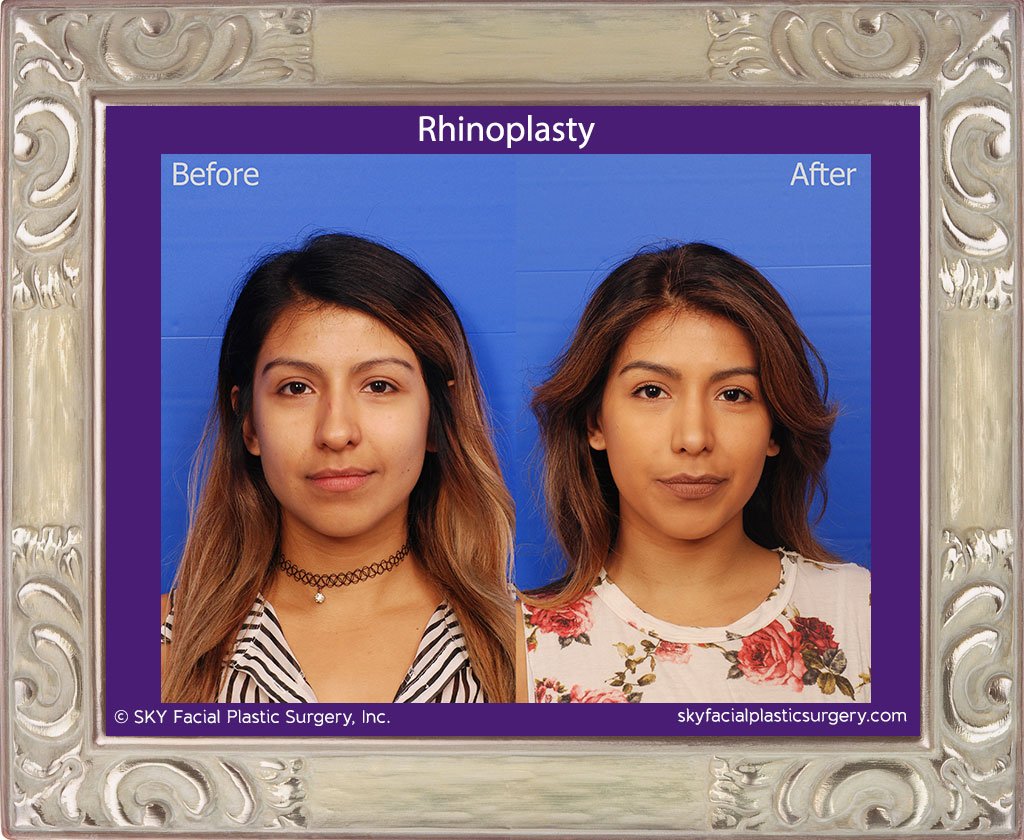 SKY-Facial-Plastic-Surgery-Rhinoplasty-36A.jpg