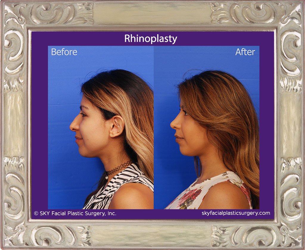 SKY-Facial-Plastic-Surgery-Rhinoplasty-36B.jpg