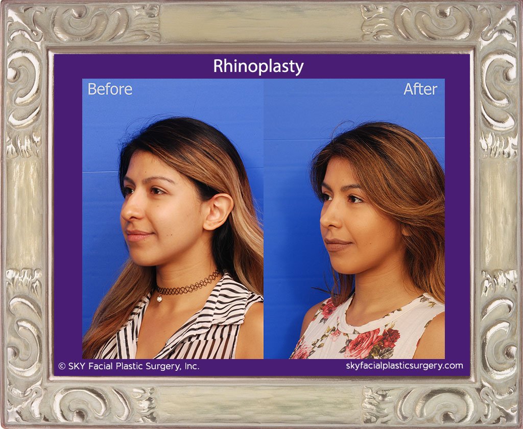 SKY-Facial-Plastic-Surgery-Rhinoplasty-36C.jpg
