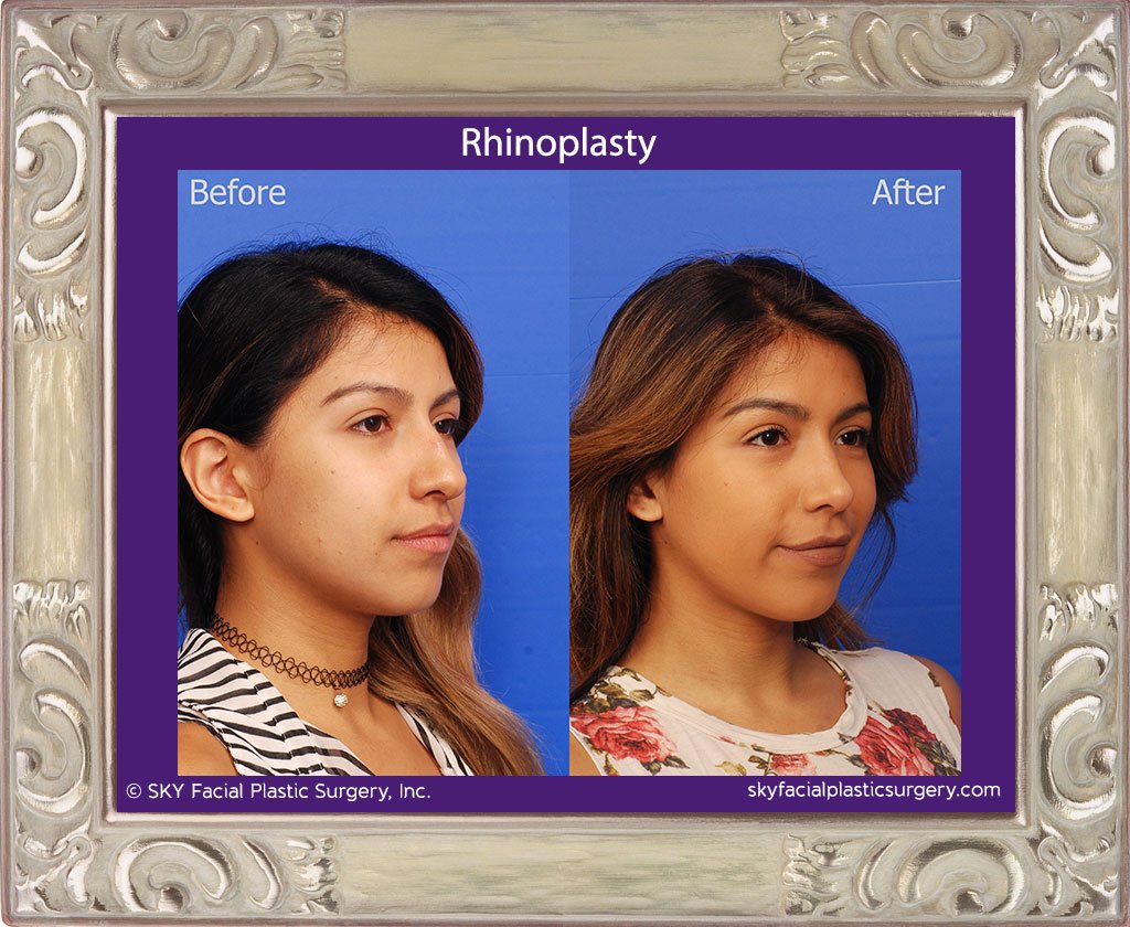 SKY-Facial-Plastic-Surgery-Rhinoplasty-36D.jpg