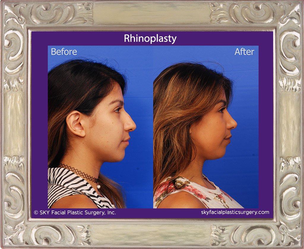 SKY-Facial-Plastic-Surgery-Rhinoplasty-36E.jpg