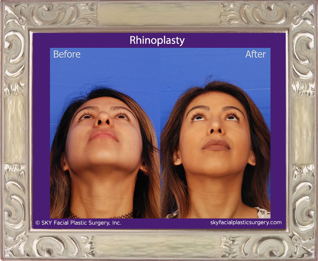 SKY-Facial-Plastic-Surgery-Rhinoplasty-36F.jpg