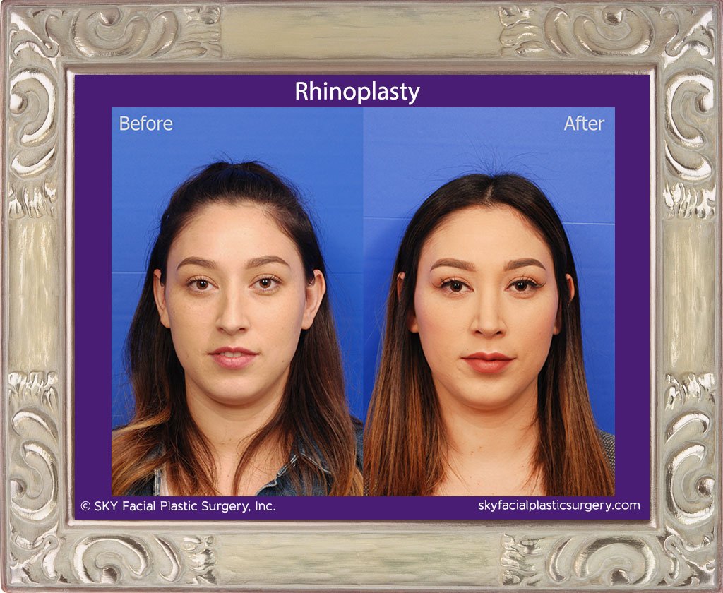SKY-Facial-Plastic-Surgery-Rhinoplasty-37A.jpg