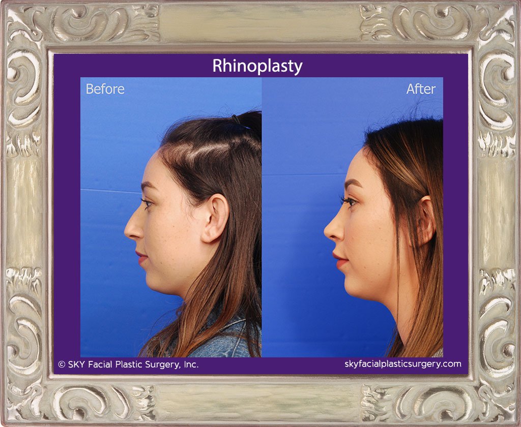 SKY-Facial-Plastic-Surgery-Rhinoplasty-37B.jpg