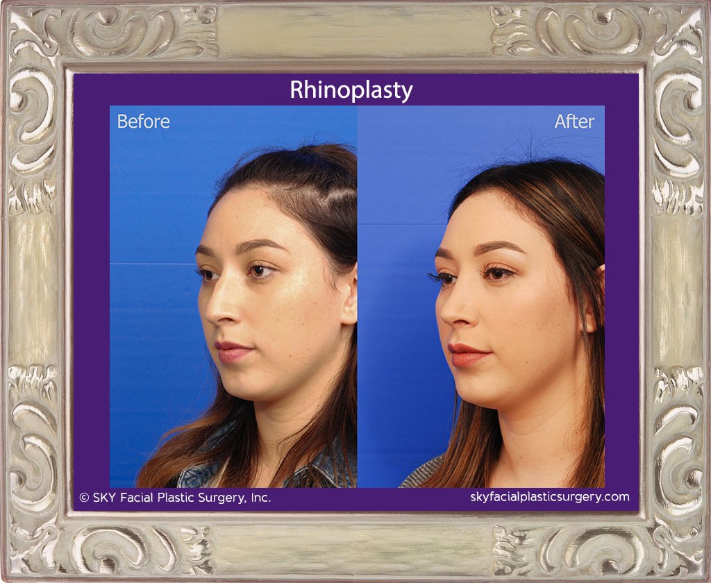 SKY-Facial-Plastic-Surgery-Rhinoplasty-37C.jpg