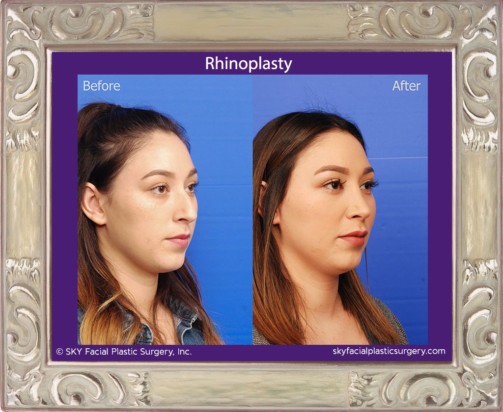 SKY-Facial-Plastic-Surgery-Rhinoplasty-37D.jpg