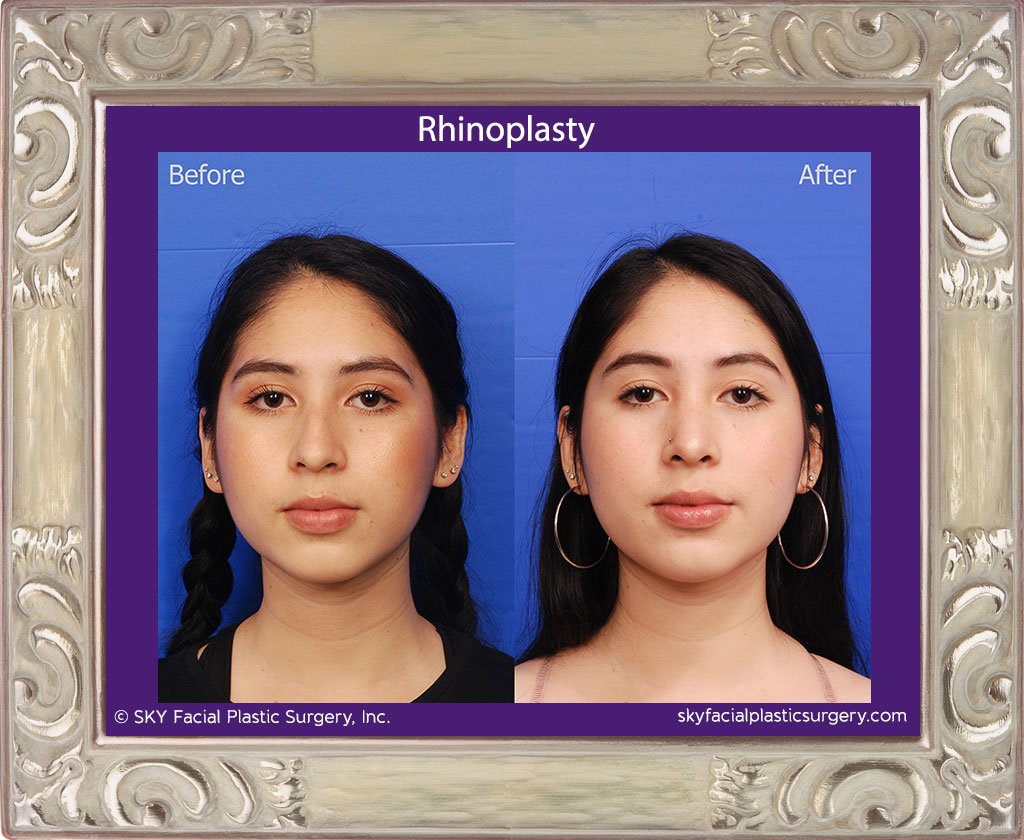 SKY-Facial-Plastic-Surgery-Rhinoplasty-38A.jpg