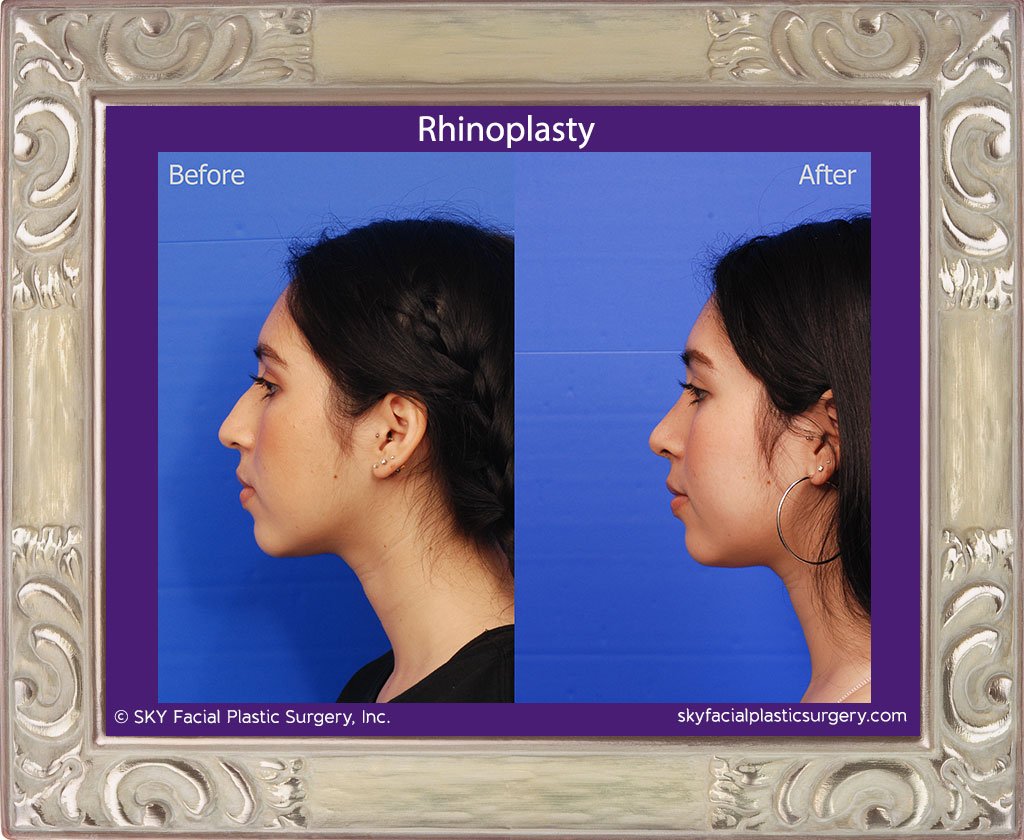 SKY-Facial-Plastic-Surgery-Rhinoplasty-38B.jpg