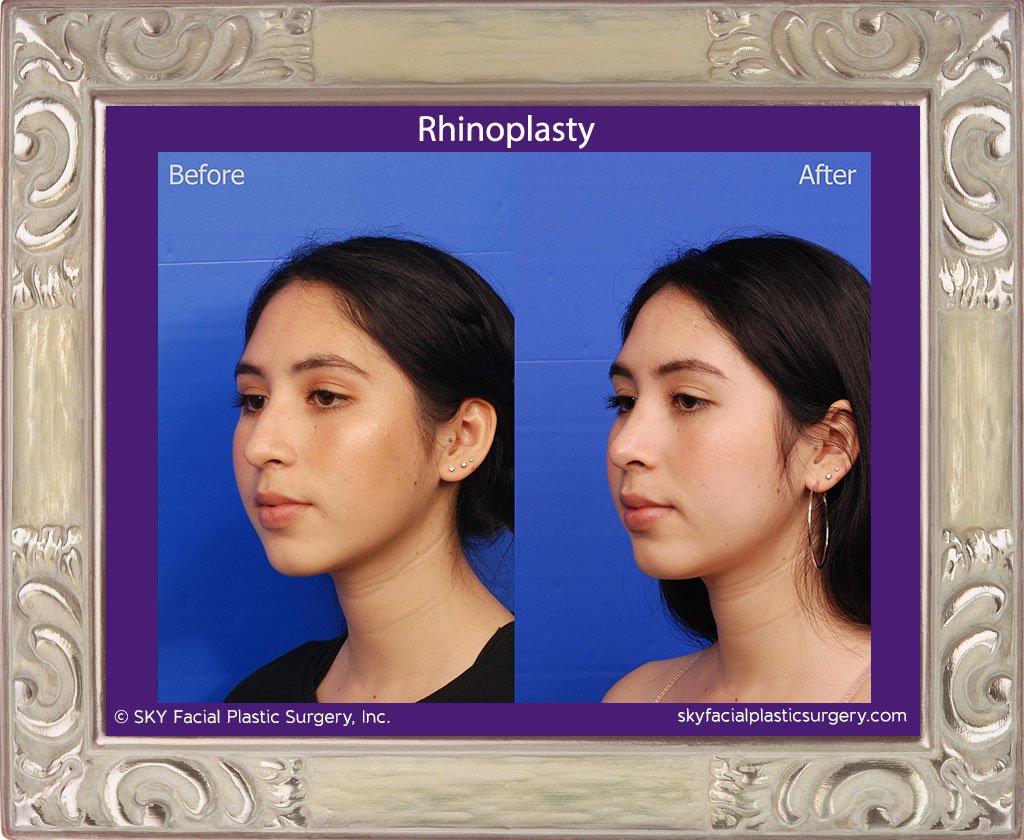 SKY-Facial-Plastic-Surgery-Rhinoplasty-38C.jpg
