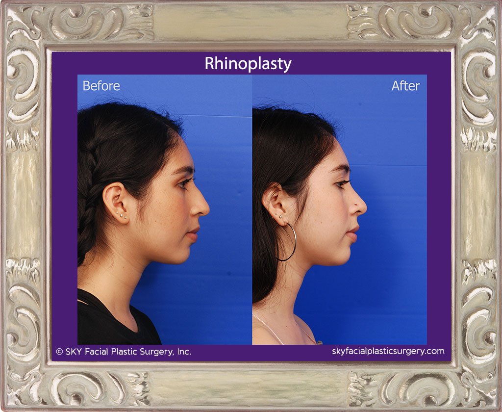 SKY-Facial-Plastic-Surgery-Rhinoplasty-38E.jpg