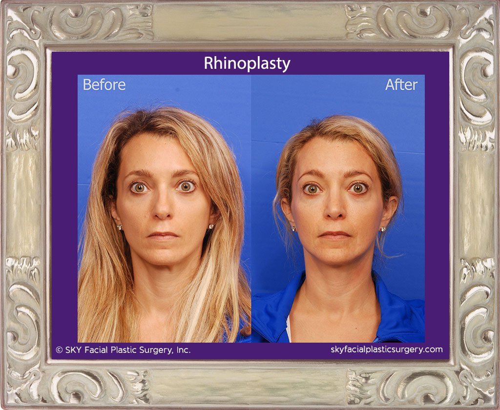 SKY-Facial-Plastic-Surgery-Rhinoplasty-39A.jpg
