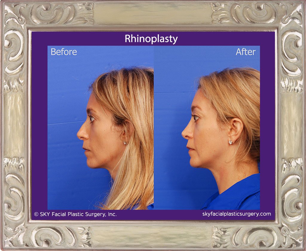 SKY-Facial-Plastic-Surgery-Rhinoplasty-39B.jpg