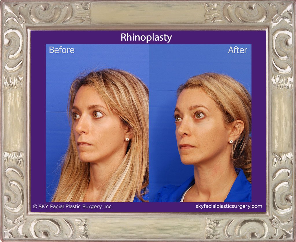 SKY-Facial-Plastic-Surgery-Rhinoplasty-39C.jpg