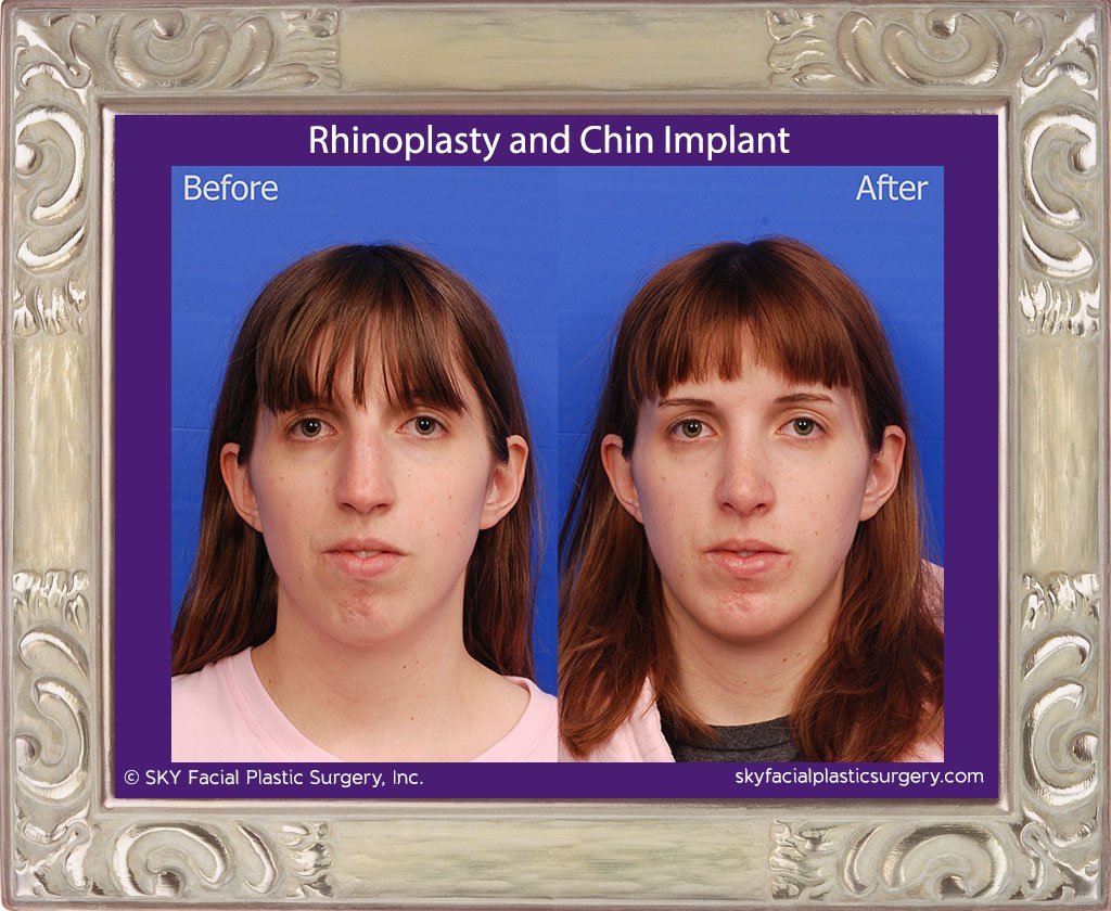 SKY-Facial-Plastic-Surgery-Rhinoplasty-40A.jpg
