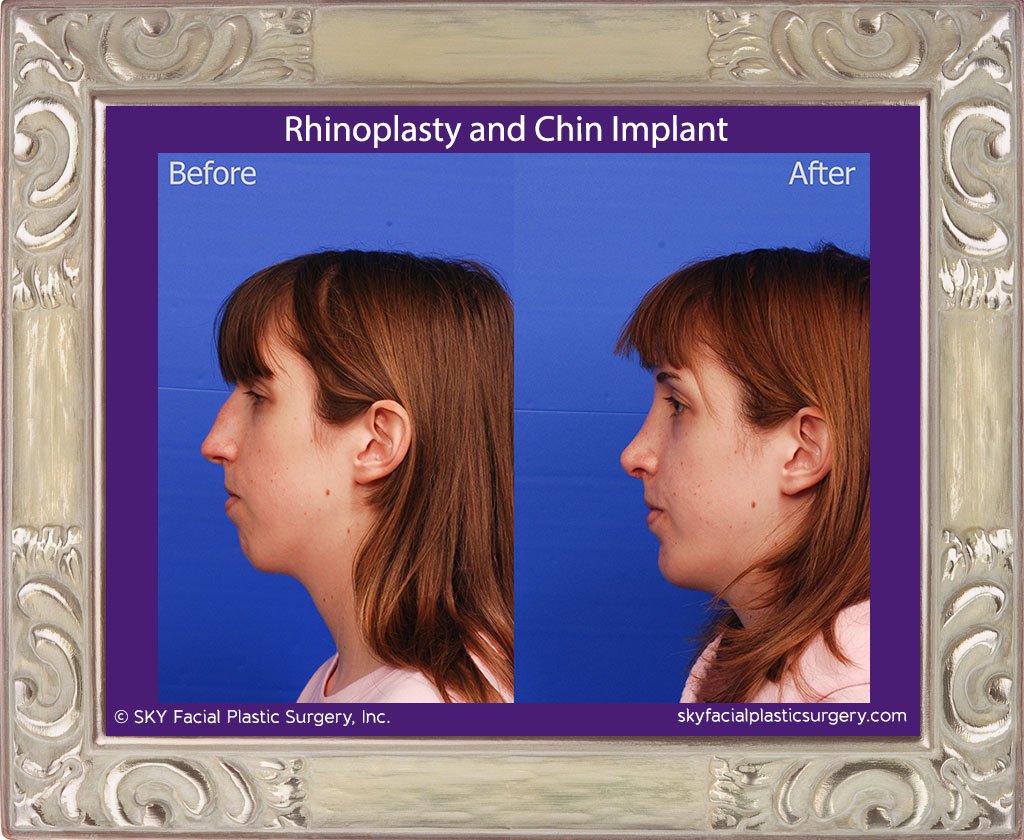 SKY-Facial-Plastic-Surgery-Rhinoplasty-40B.jpg