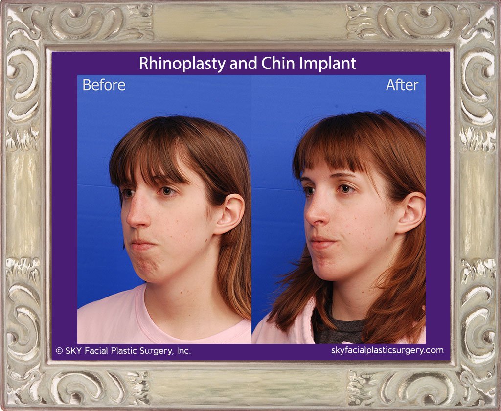 SKY-Facial-Plastic-Surgery-Rhinoplasty-40C.jpg