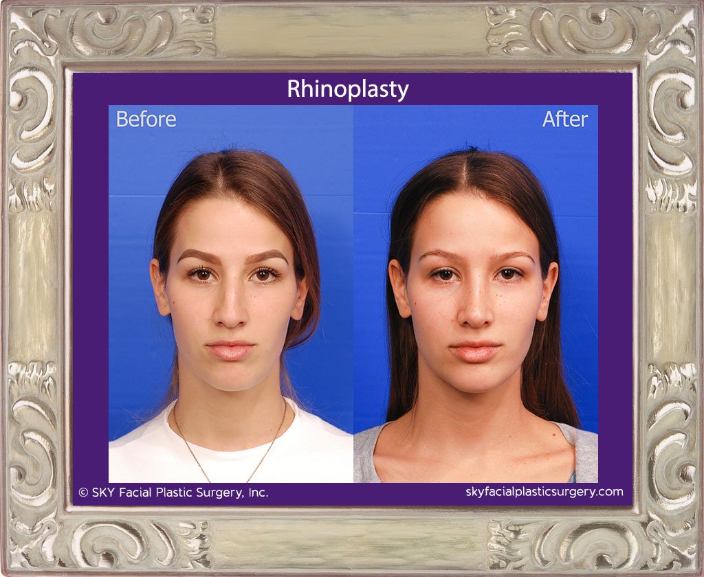 SKY-Facial-Plastic-Surgery-Rhinoplasty-41A.jpg