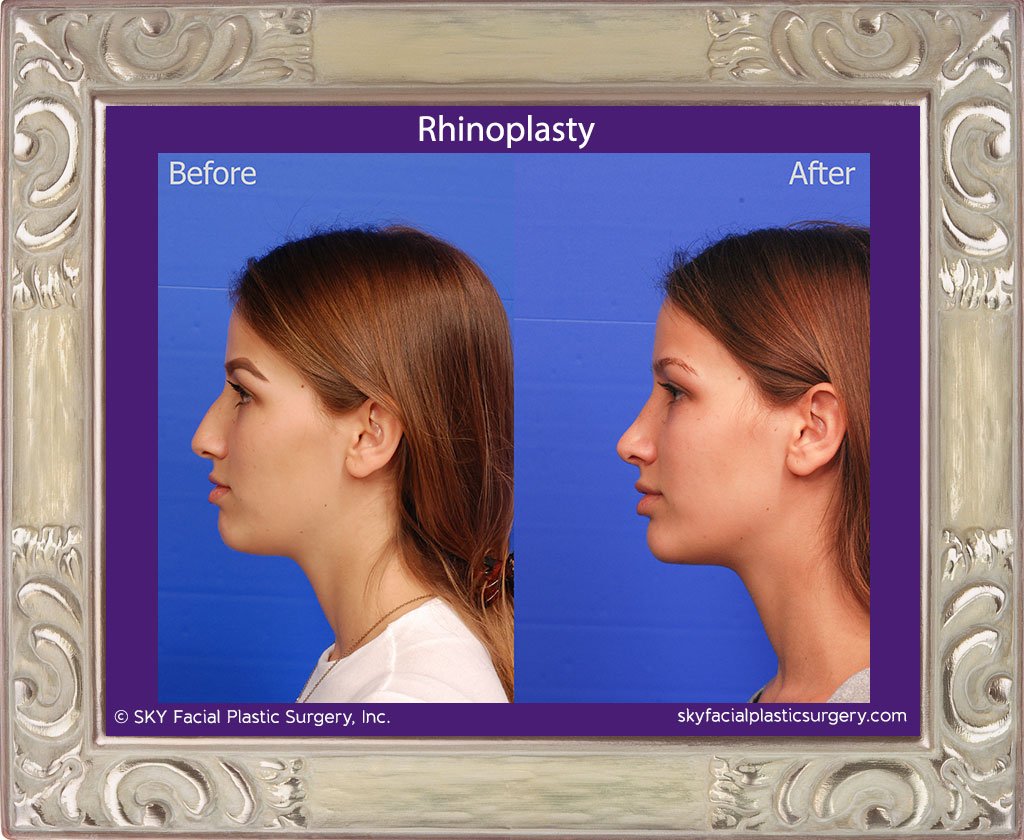 SKY-Facial-Plastic-Surgery-Rhinoplasty-41B.jpg