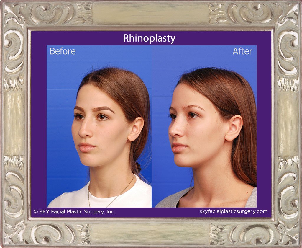 SKY-Facial-Plastic-Surgery-Rhinoplasty-41C.jpg