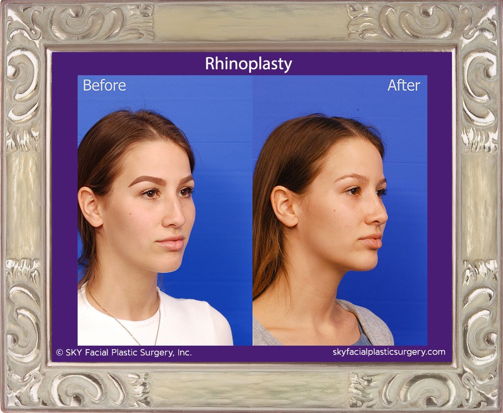 SKY-Facial-Plastic-Surgery-Rhinoplasty-41D.jpg
