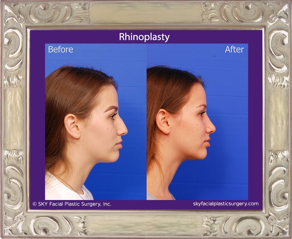SKY-Facial-Plastic-Surgery-Rhinoplasty-41E.jpg