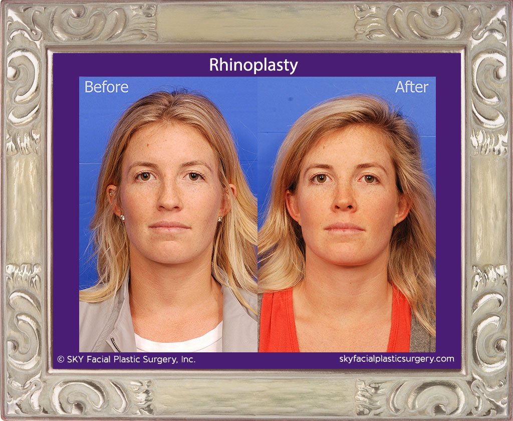 SKY-Facial-Plastic-Surgery-Rhinoplasty-42A.jpg