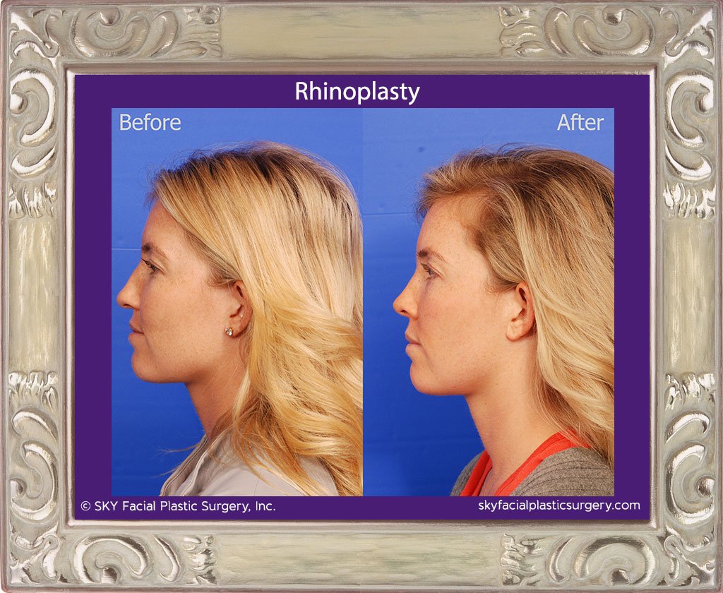 SKY-Facial-Plastic-Surgery-Rhinoplasty-42B.jpg