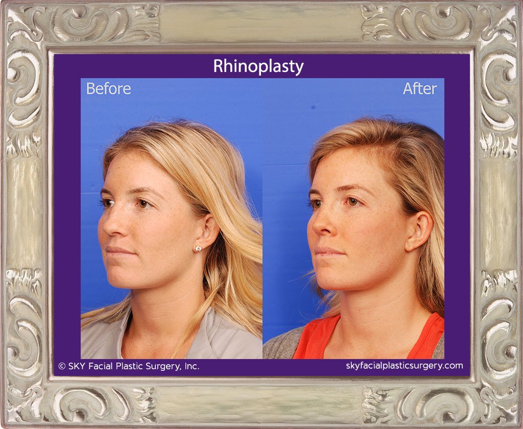 SKY-Facial-Plastic-Surgery-Rhinoplasty-42C.jpg